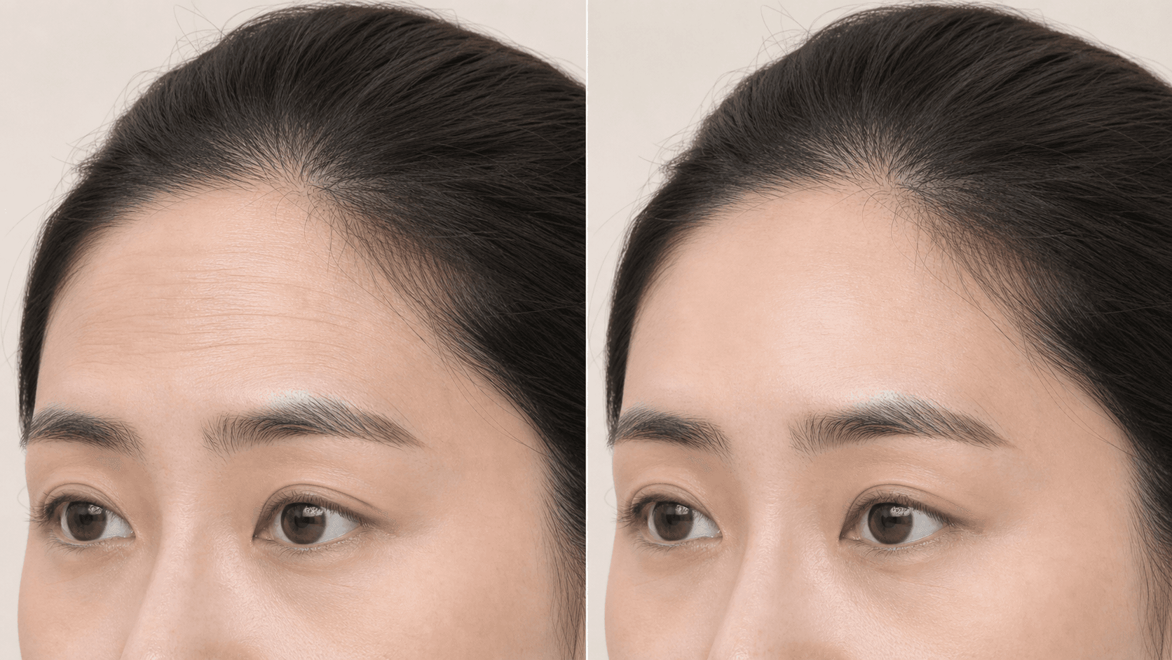 AI-generated reference image for Forehead filler + Botox